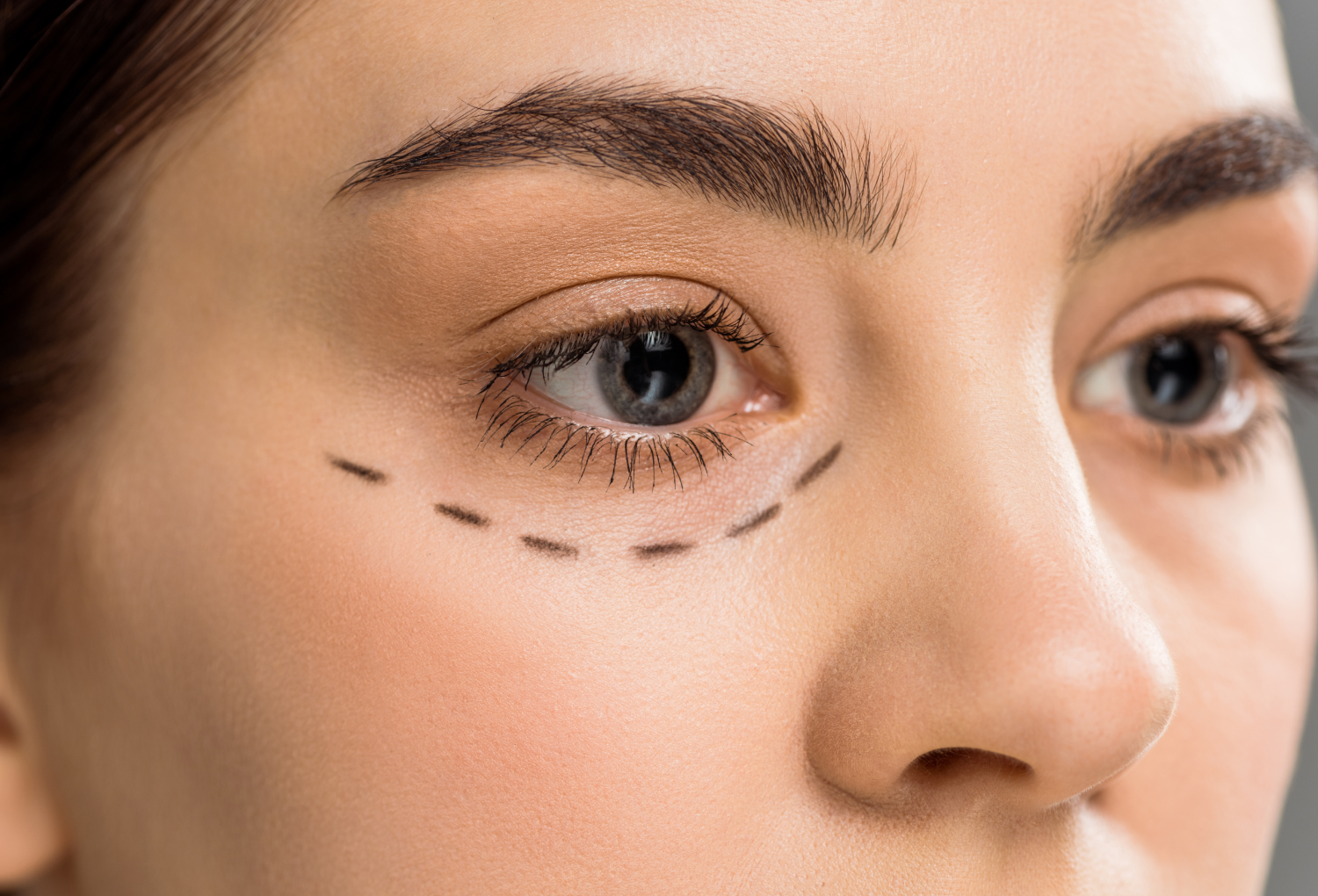 Blefaroplastia (Cirurgia das Pálpebras)